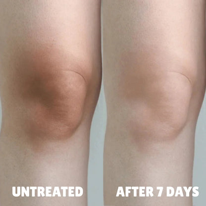 Advanced Triple-Acid Complex for Hyperpigmentation
